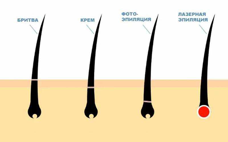 Депиляция различия. Виды эпиляции. Виды лазерной эпиляции. Депиляция и эпиляция разница. Типы лазеров для эпиляции.