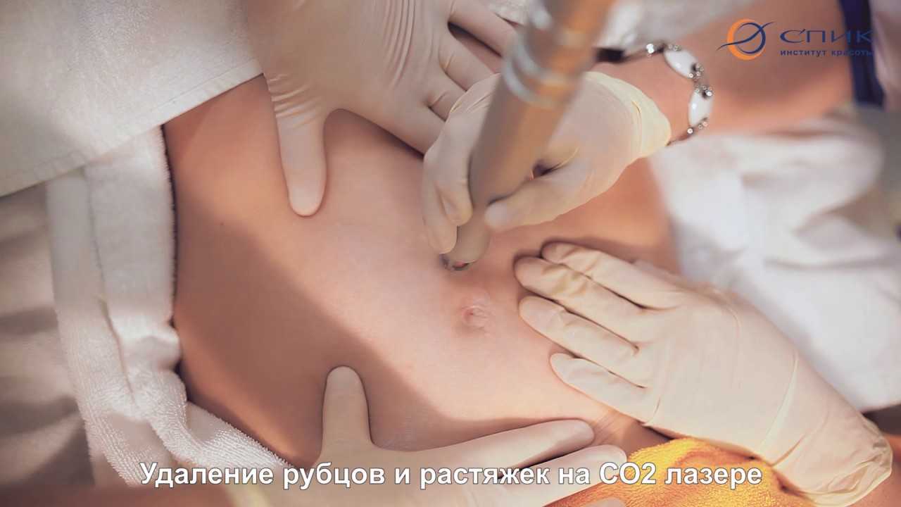 Хирургическое иссечение рубцов на лице и теле, особенности операции по иссечению рубца