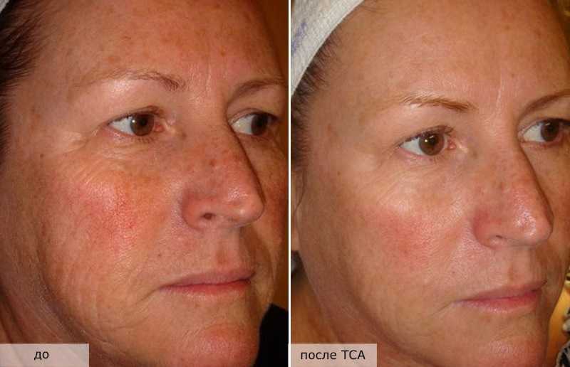 Тиогамма для лица – чистая и красивая кожа (топ-10 рецептов)