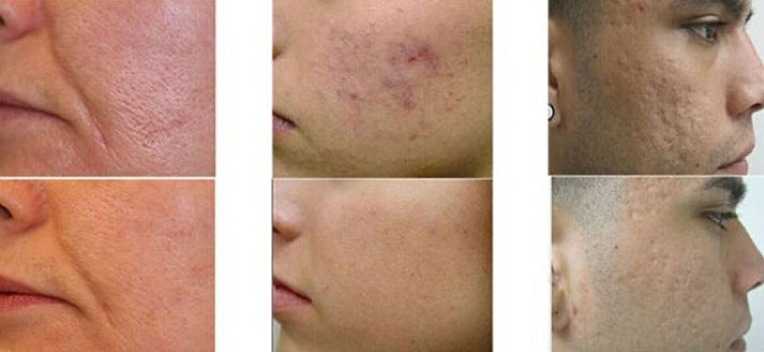 Как убрать и уменьшить рубцы на коже лица после операции: лечение в пластической косметологии, удаление, заживление послеоперационных шрамов от швов, что делать и чем избавиться