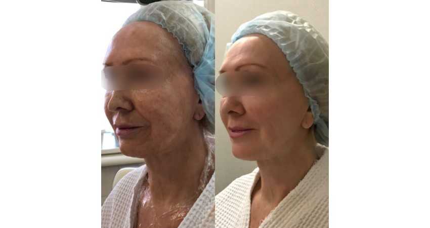 Игольчатый рф лифтинг лица фото сразу после процедуры