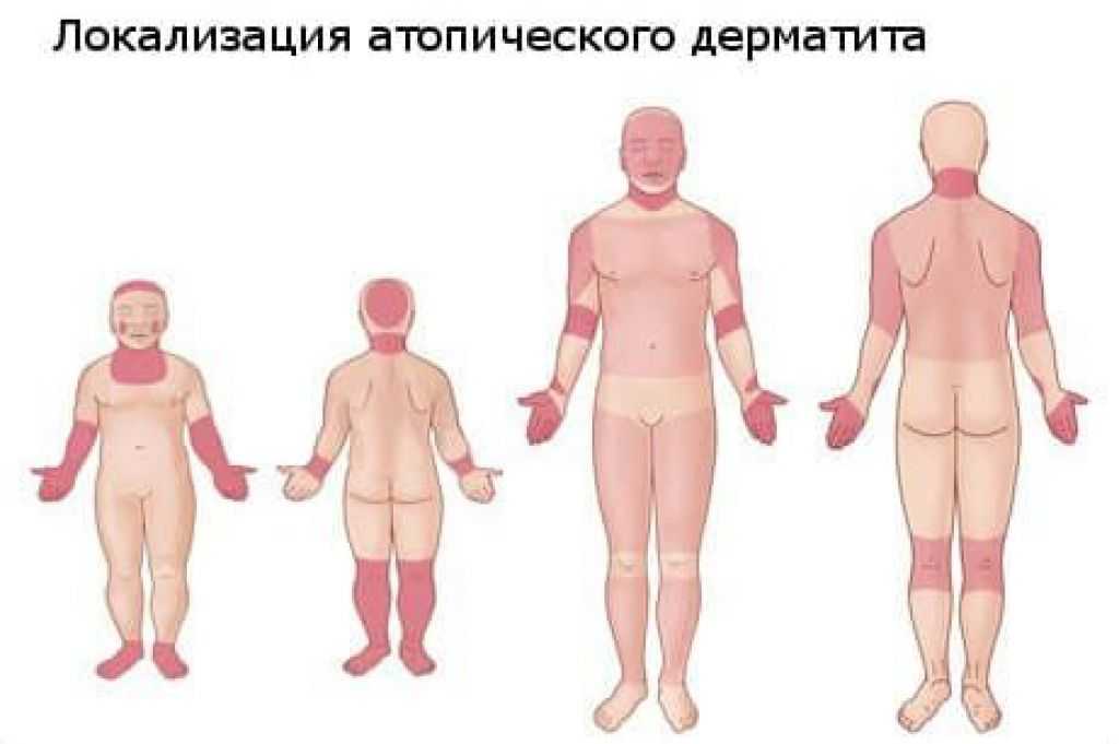Контактный дерматит - лечение и профилактика