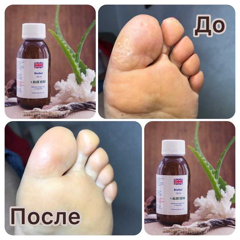 Что такое кислотный педикюр?
