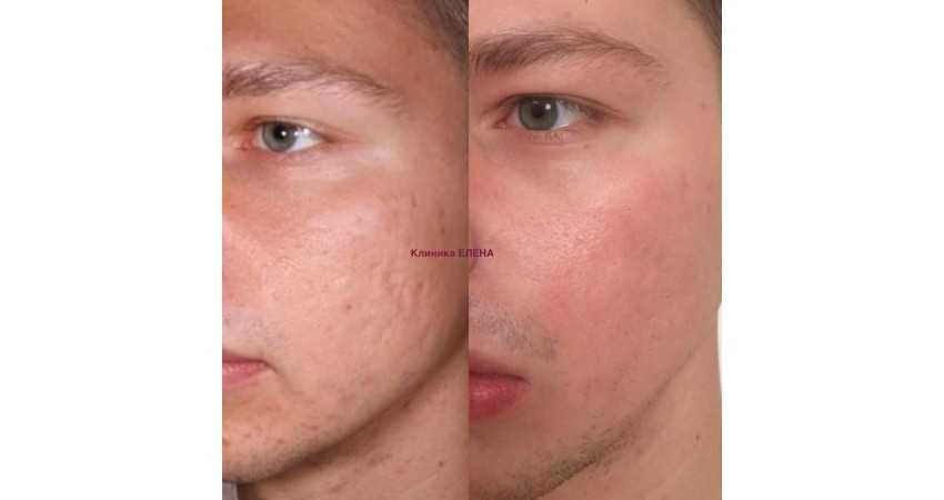 Лазерная шлифовка (дермабразия) кожи лица, рубцов, шрамов, растяжек
